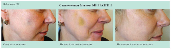 С применением Бальзама Мирралгин